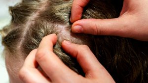 Can You Use Dog Shampoo on Head Lice?
