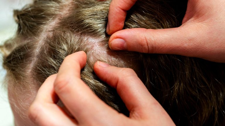 Can You Use Dog Shampoo on Head Lice?