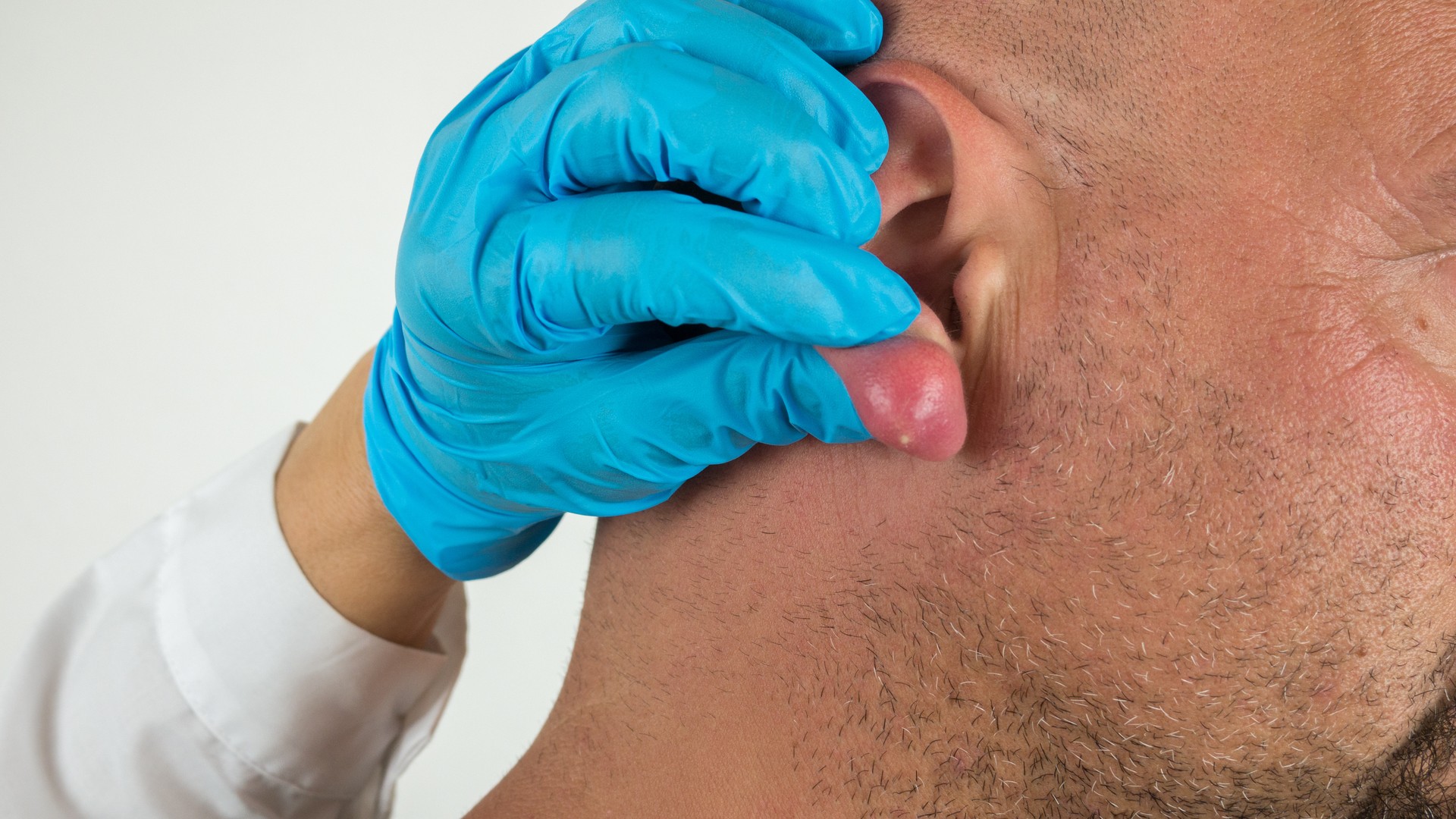 Gloved hand checking skin near the hairline and ear, representing the bite and reaction science behind lice blood-type questions.